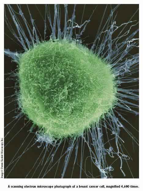 Electron micrograph of breast cancer cell